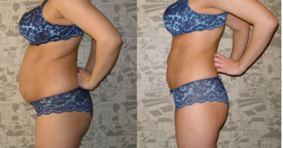 hcg-diet-pictures-before-after-2